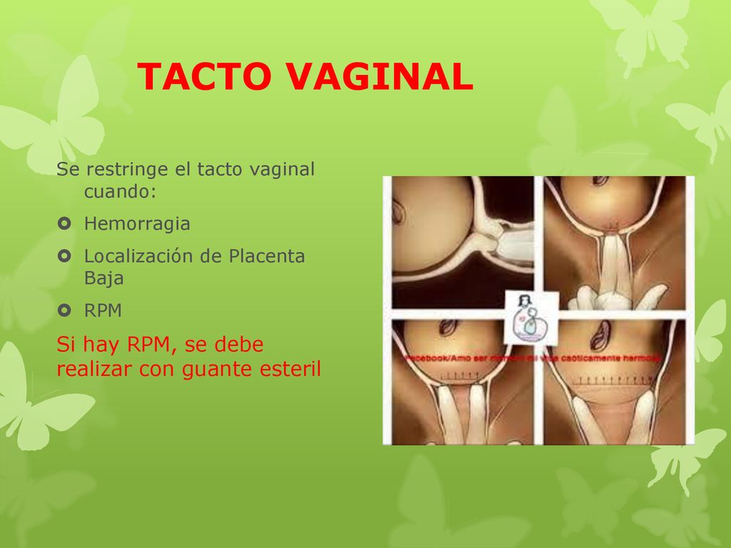 TACTO VAGINAL Si hay RPM, se debe realizar con guante esteril