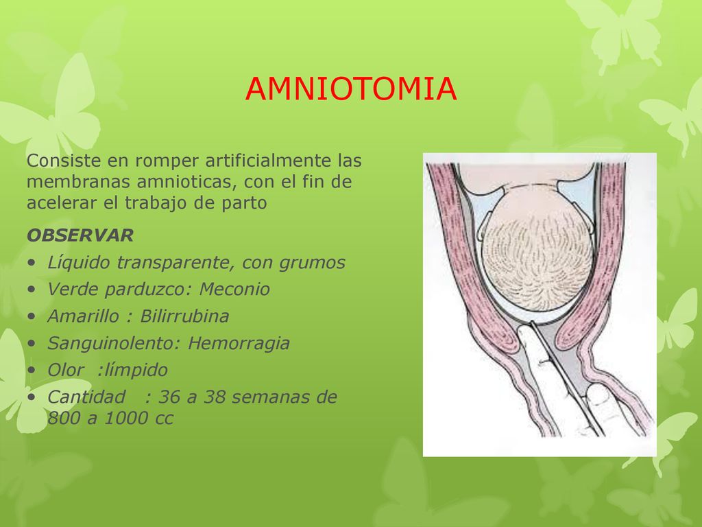 AMNIOTOMIA Consiste en romper artificialmente las membranas amnioticas, con el fin de acelerar el trabajo de parto.