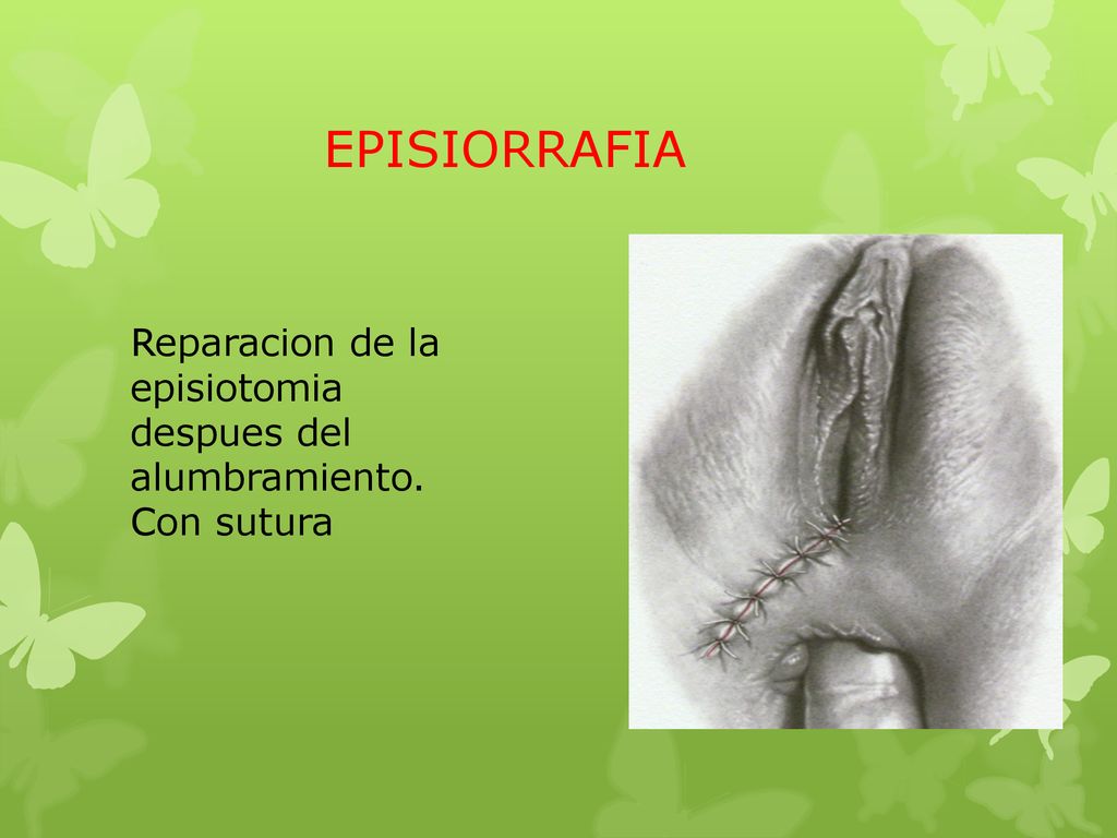 EPISIORRAFIA Reparacion de la episiotomia despues del alumbramiento. Con sutura