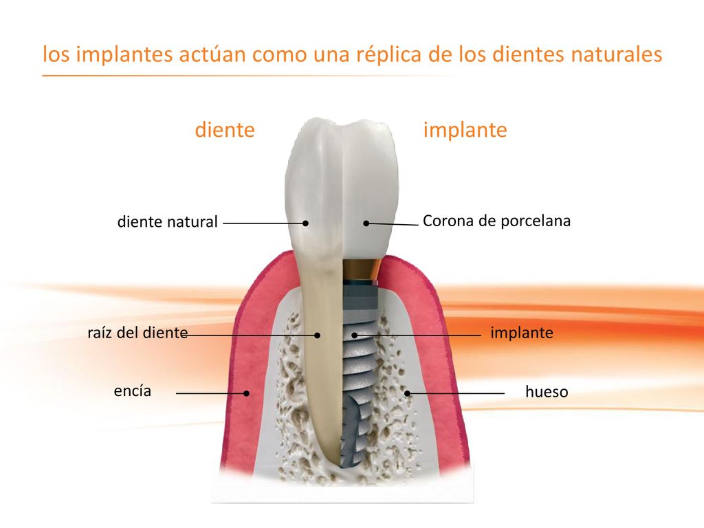 los implantes actúan como una réplica de los dientes naturales