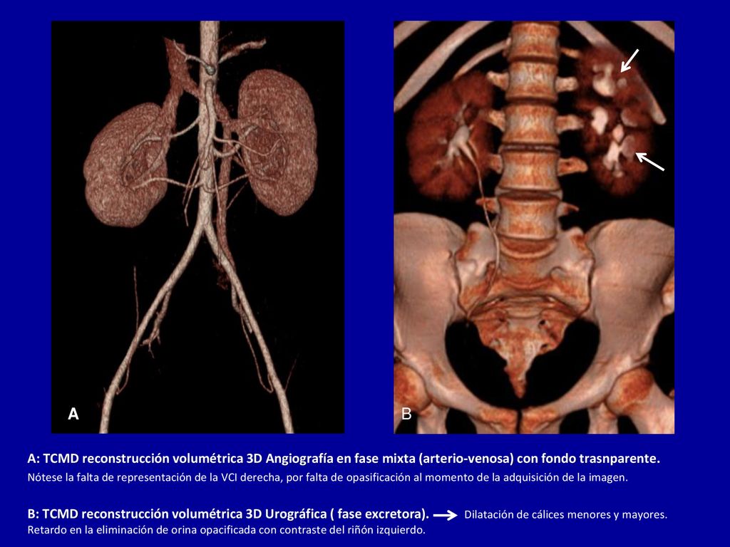 A B. A: TCMD reconstrucción volumétrica 3D Angiografía en fase mixta (arterio-venosa) con fondo trasnparente.