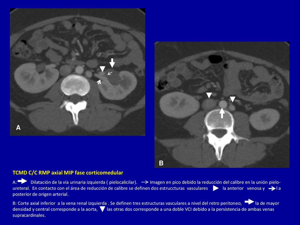 A B TCMD C/C RMP axial MIP fase corticomedular