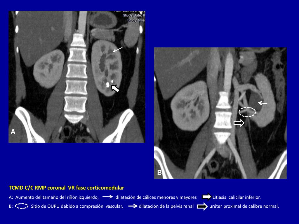 A A B TCMD C/C RMP coronal VR fase corticomedular