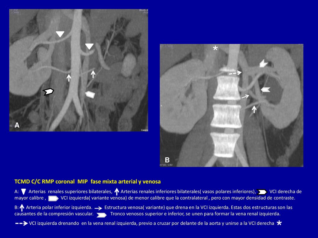 * A B TCMD C/C RMP coronal MIP fase mixta arterial y venosa