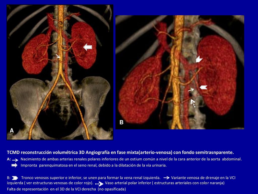 B A. TCMD reconstrucción volumétrica 3D Angiografía en fase mixta(arterio-venosa) con fondo semitrasnparente.
