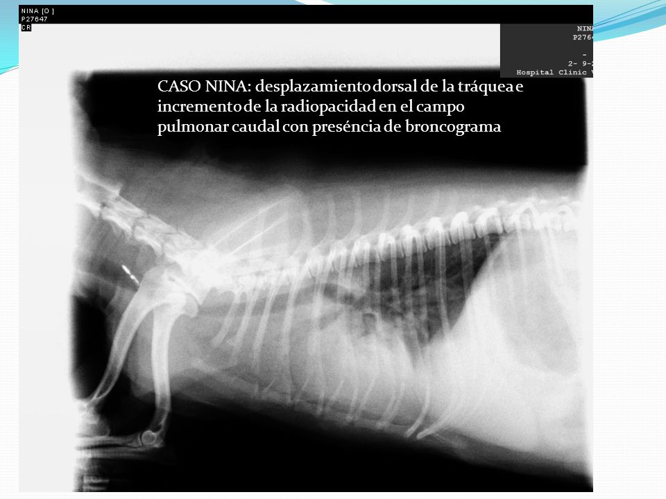 CASO NINA: desplazamiento dorsal de la tráquea e incremento de la radiopacidad en el campo pulmonar caudal con preséncia de broncograma