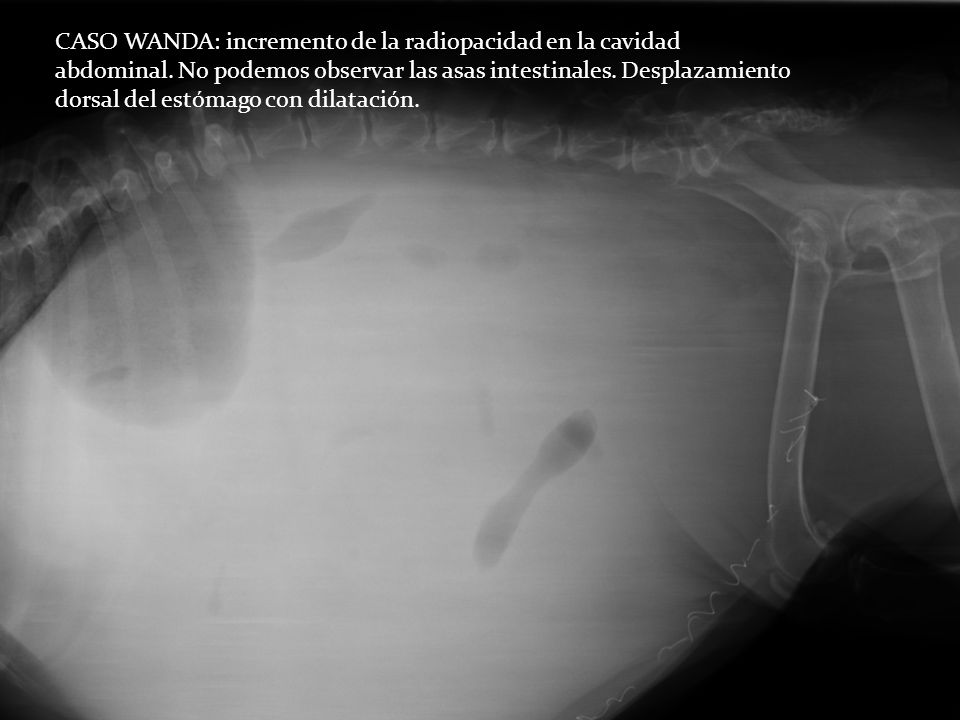 CASO WANDA: incremento de la radiopacidad en la cavidad abdominal