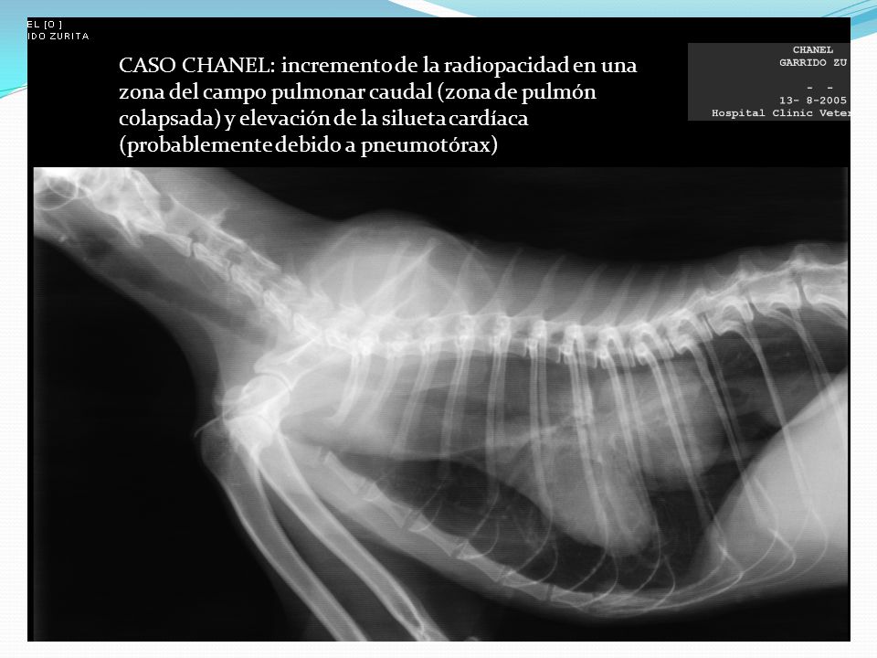 CASO CHANEL: incremento de la radiopacidad en una zona del campo pulmonar caudal (zona de pulmón colapsada) y elevación de la silueta cardíaca (probablemente debido a pneumotórax)
