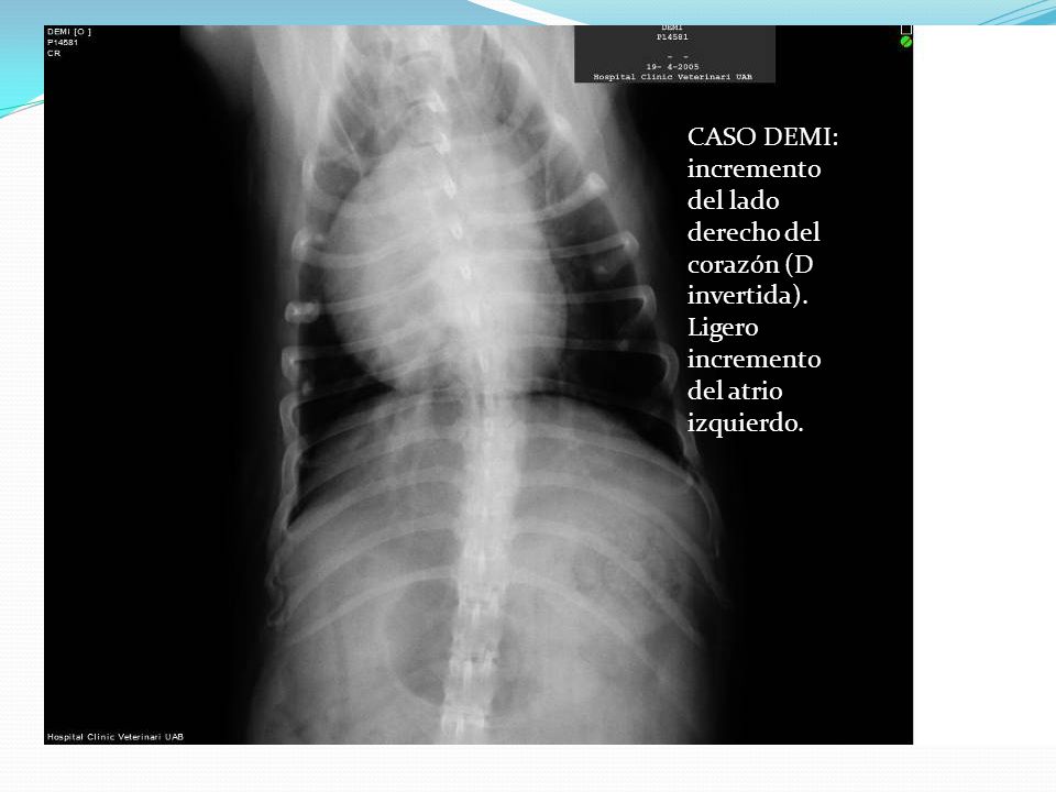 CASO DEMI: incremento del lado derecho del corazón (D invertida)