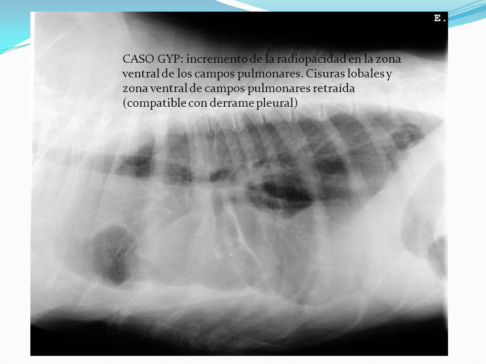 CASO GYP: incremento de la radiopacidad en la zona ventral de los campos pulmonares.