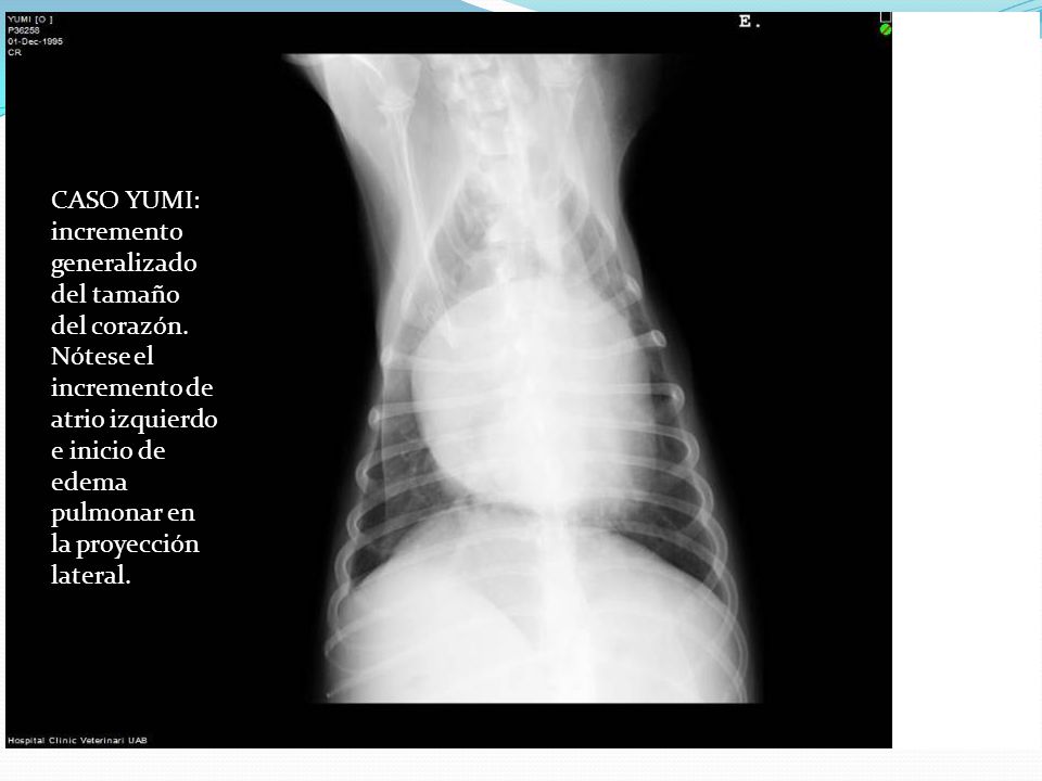 CASO YUMI: incremento generalizado del tamaño del corazón