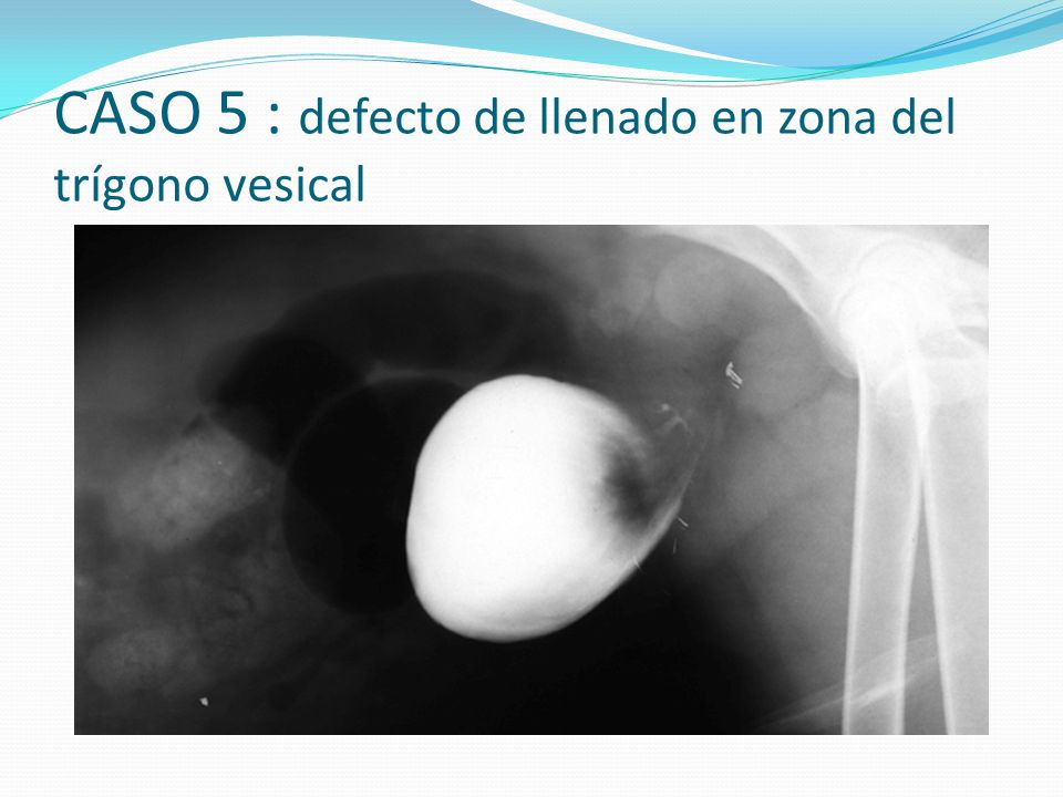 CASO 5 : defecto de llenado en zona del trígono vesical