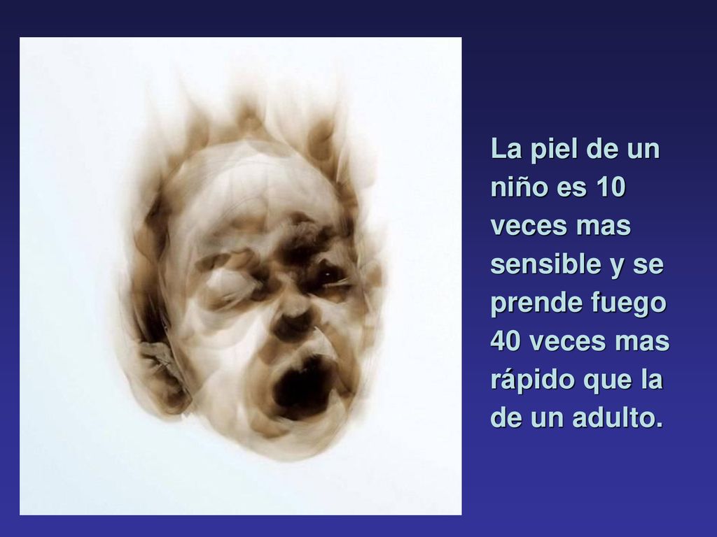 La piel de un niño es 10 veces mas sensible y se prende fuego 40 veces mas rápido que la de un adulto.