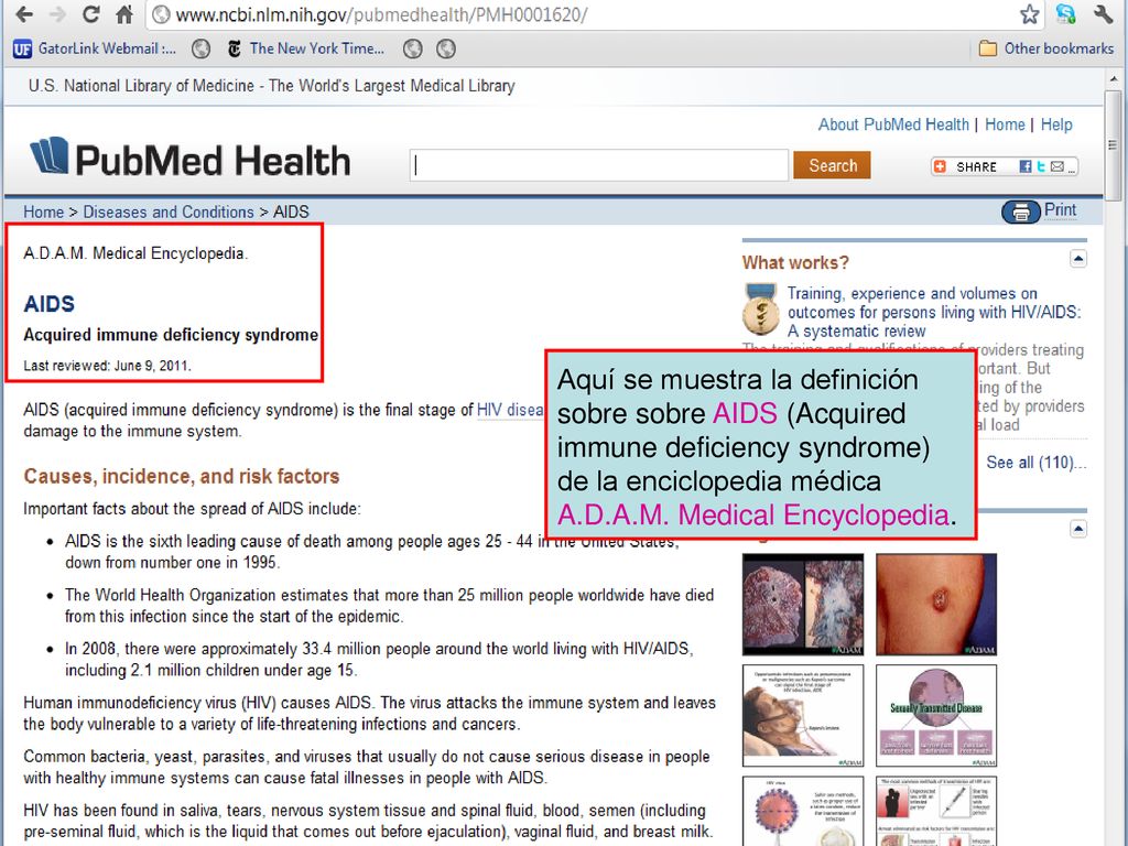 Aquí se muestra la definición sobre sobre AIDS (Acquired immune deficiency syndrome) de la enciclopedia médica A.D.A.M.