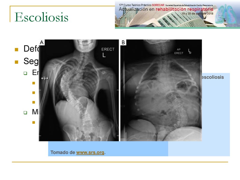 Escoliosis Deformidad tridimensional del raquis . Según SRS 2 grupos: