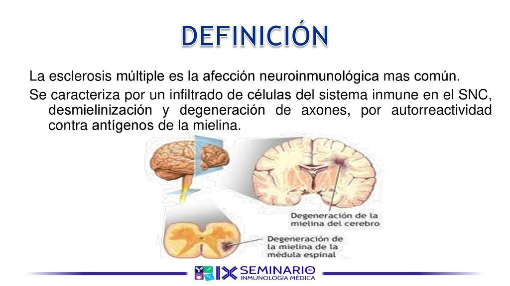 DEFINICIÓN La esclerosis múltiple es la afección neuroinmunológica mas común.