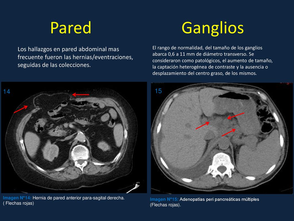 Pared Ganglios Los hallazgos en pared abdominal mas frecuente fueron las hernias/eventraciones, seguidas de las colecciones.
