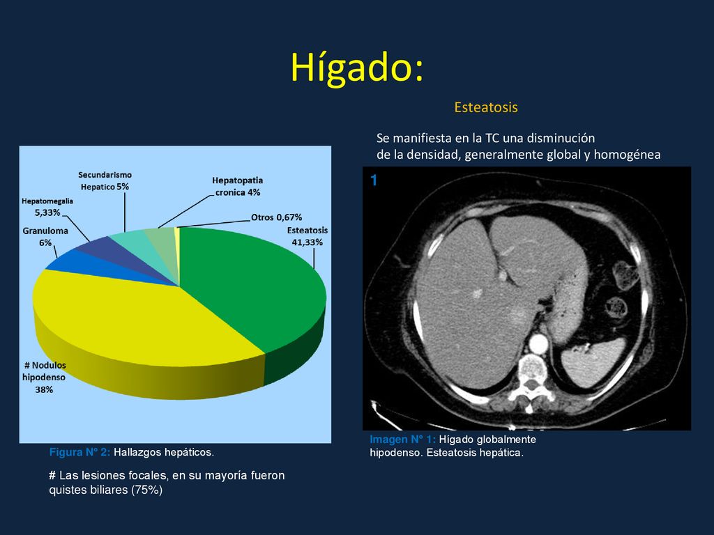 Hígado: Esteatosis 1 Se manifiesta en la TC una disminución