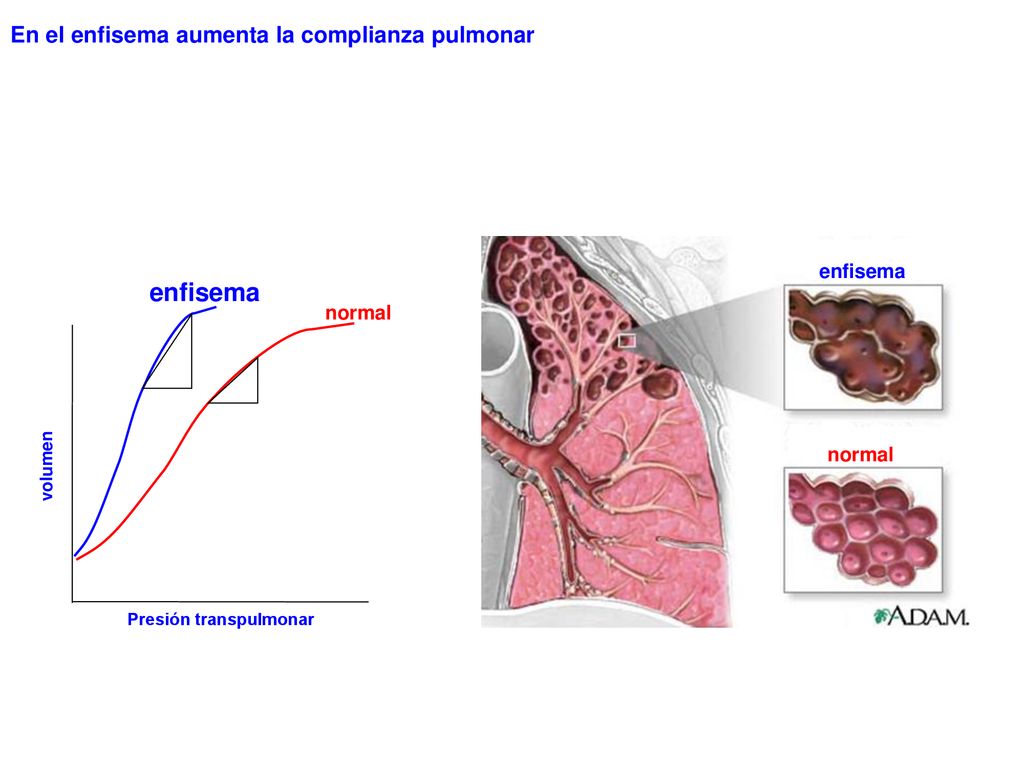 enfisema En el enfisema aumenta la complianza pulmonar enfisema normal