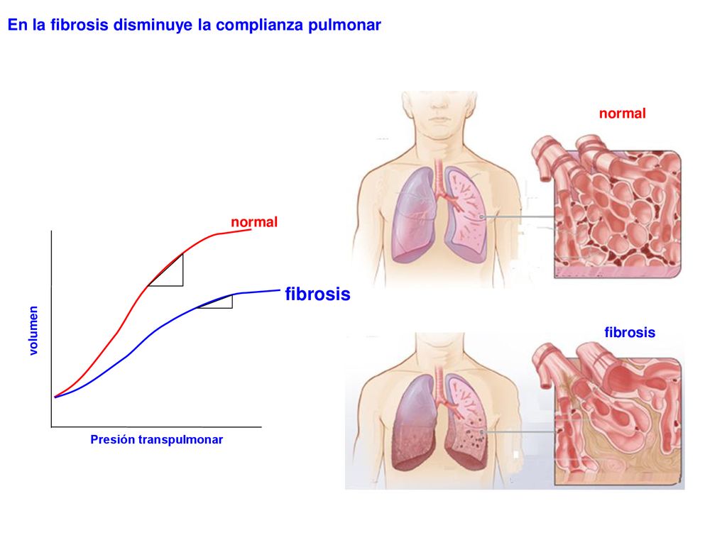 fibrosis En la fibrosis disminuye la complianza pulmonar normal normal