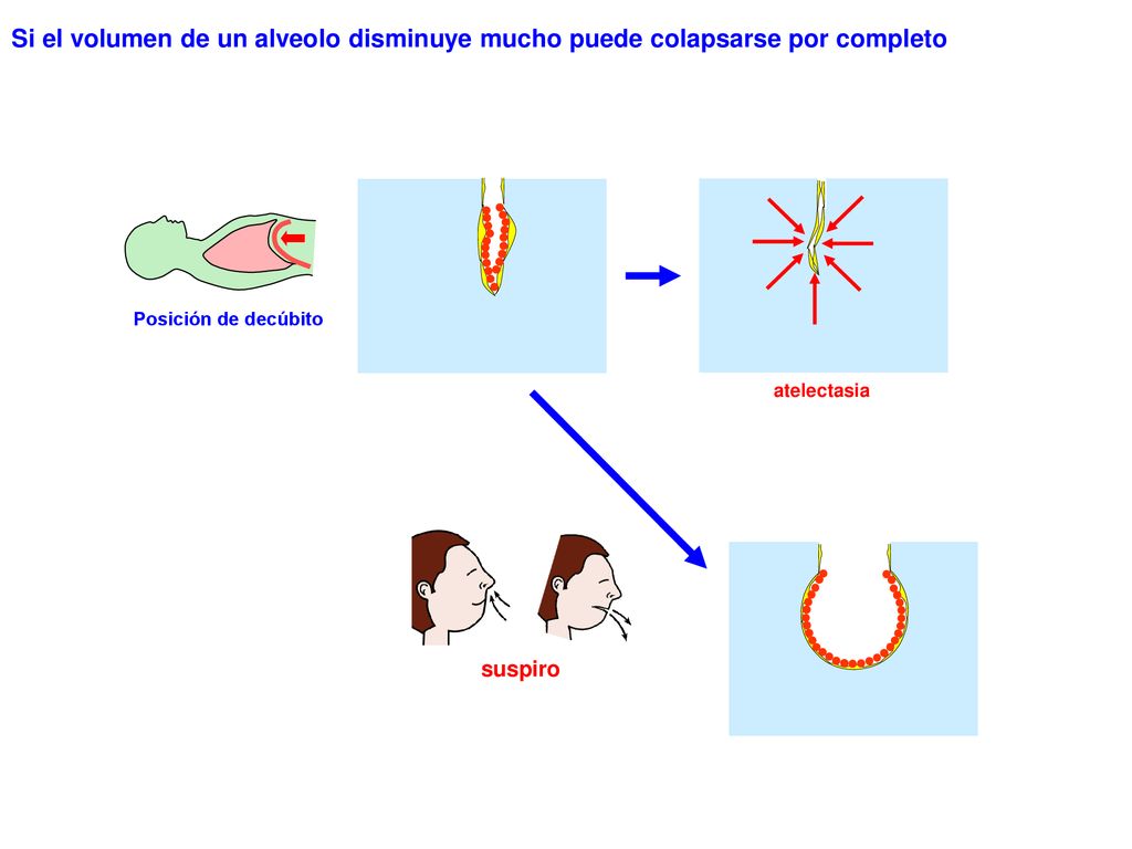 Si el volumen de un alveolo disminuye mucho puede colapsarse por completo