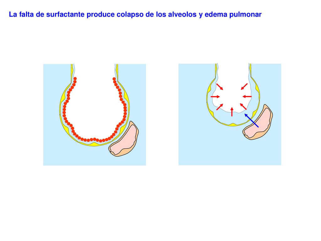 La falta de surfactante produce colapso de los alveolos y edema pulmonar