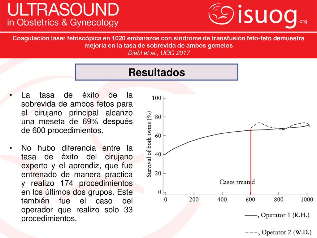 Coagulación laser fetoscópica en 1020 embarazos con síndrome de transfusión feto-feto demuestra mejoría en la tasa de sobrevida de ambos gemelos