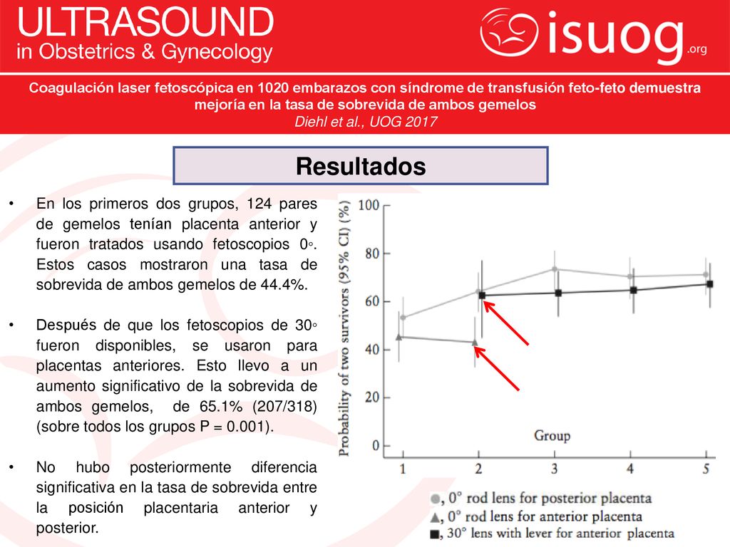Coagulación laser fetoscópica en 1020 embarazos con síndrome de transfusión feto-feto demuestra mejoría en la tasa de sobrevida de ambos gemelos