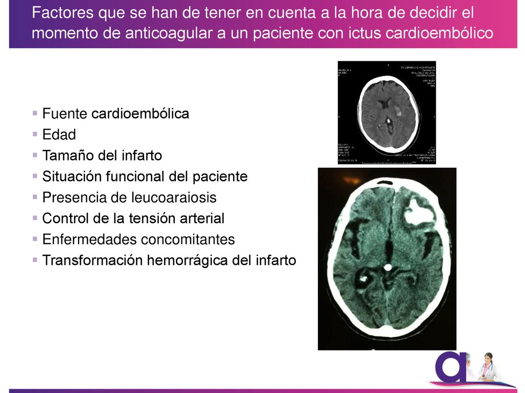 Factores que se han de tener en cuenta a la hora de decidir el momento de anticoagular a un paciente con ictus cardioembólico