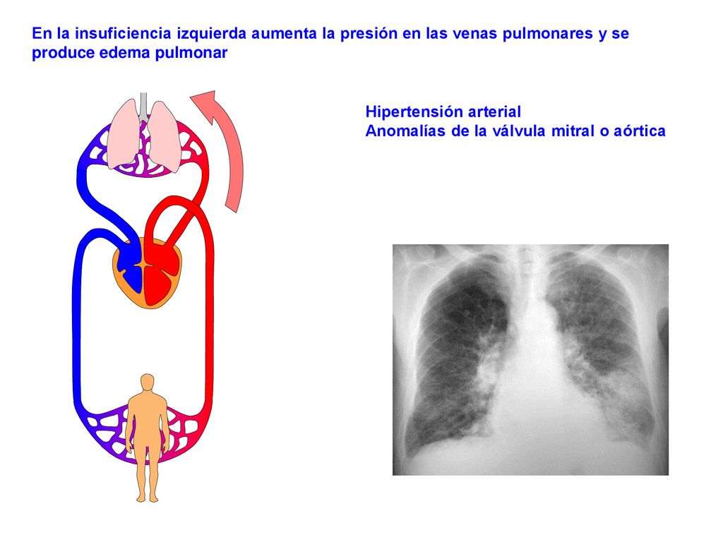 En la insuficiencia izquierda aumenta la presión en las venas pulmonares y se produce edema pulmonar