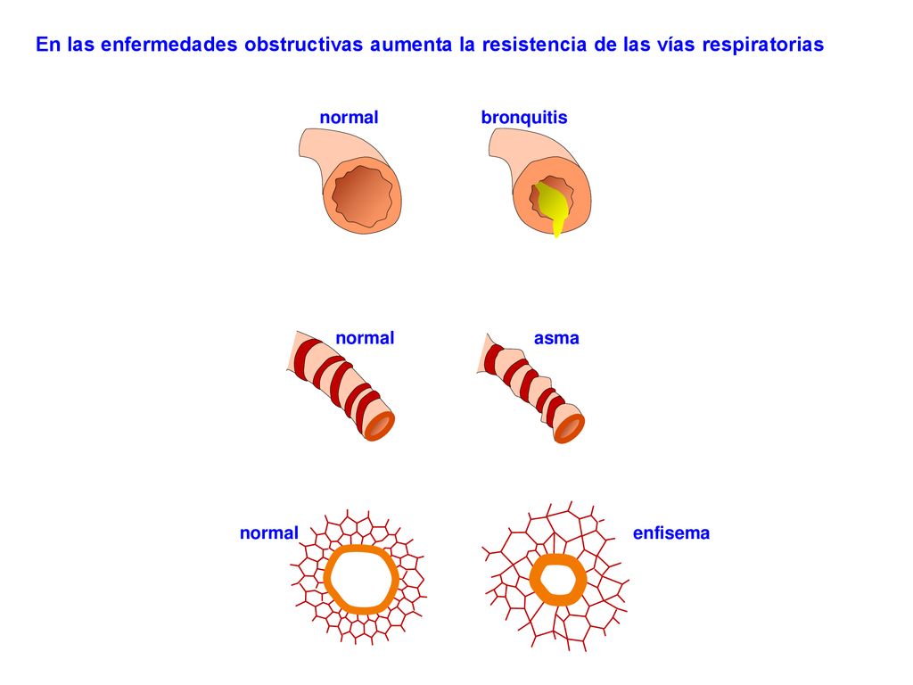 En las enfermedades obstructivas aumenta la resistencia de las vías respiratorias