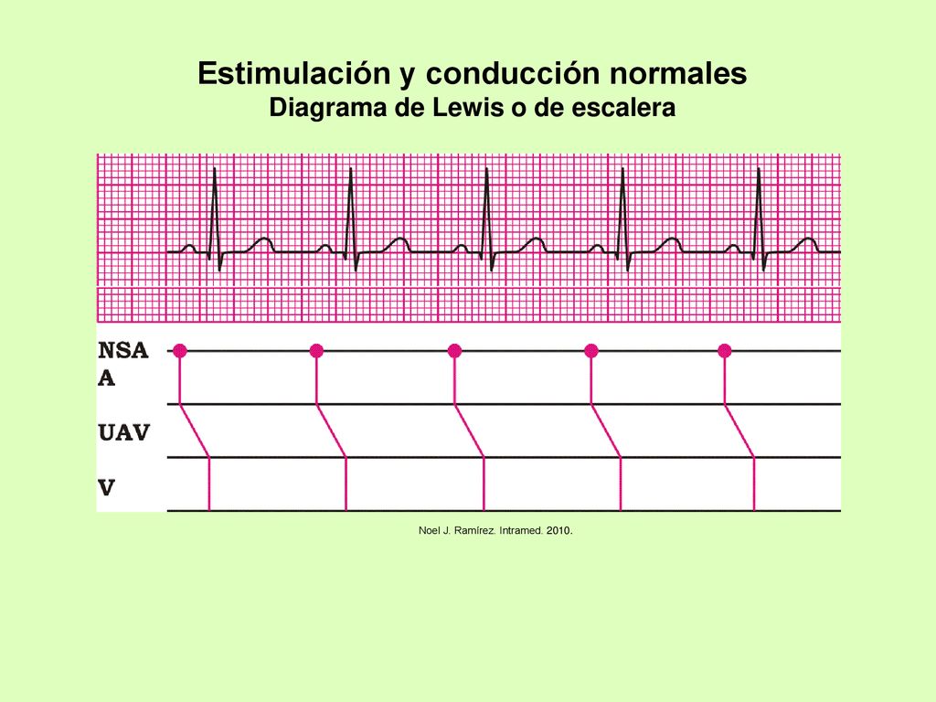 Estimulación y conducción normales Diagrama de Lewis o de escalera