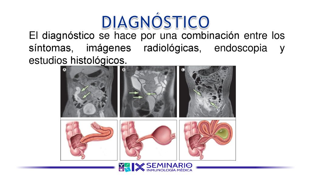 DIAGNÓSTICO El diagnóstico se hace por una combinación entre los síntomas, imágenes radiológicas, endoscopia y estudios histológicos.