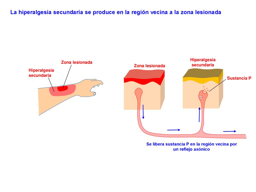 La hiperalgesia secundaria se produce en la región vecina a la zona lesionada