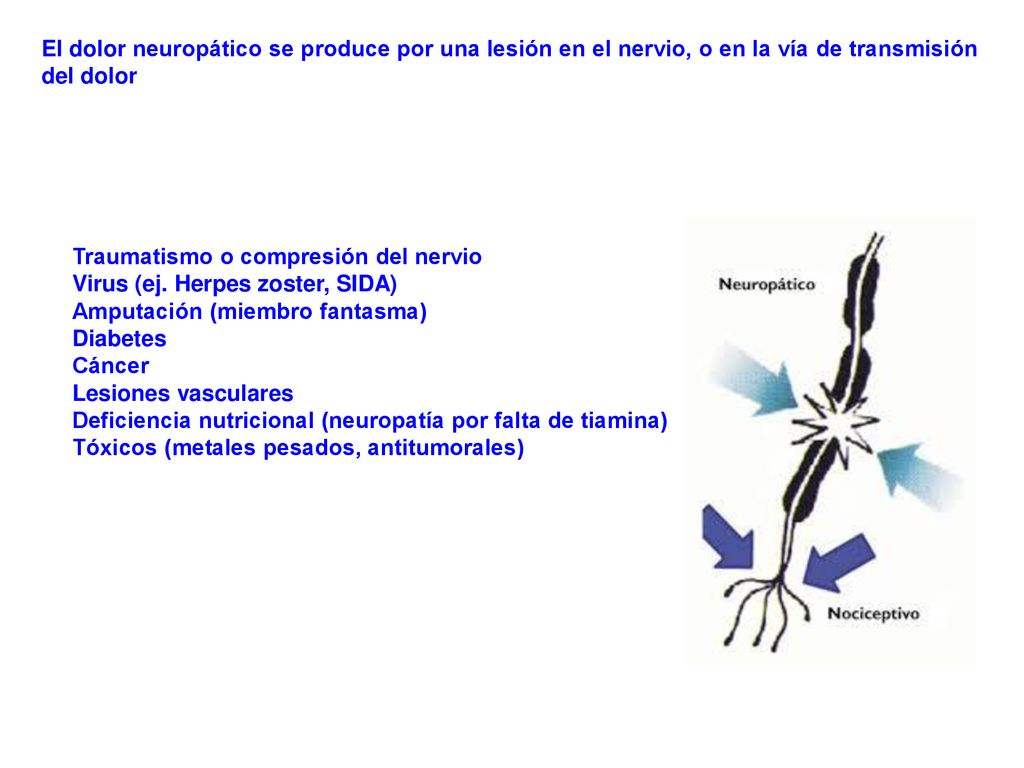 El dolor neuropático se produce por una lesión en el nervio, o en la vía de transmisión del dolor