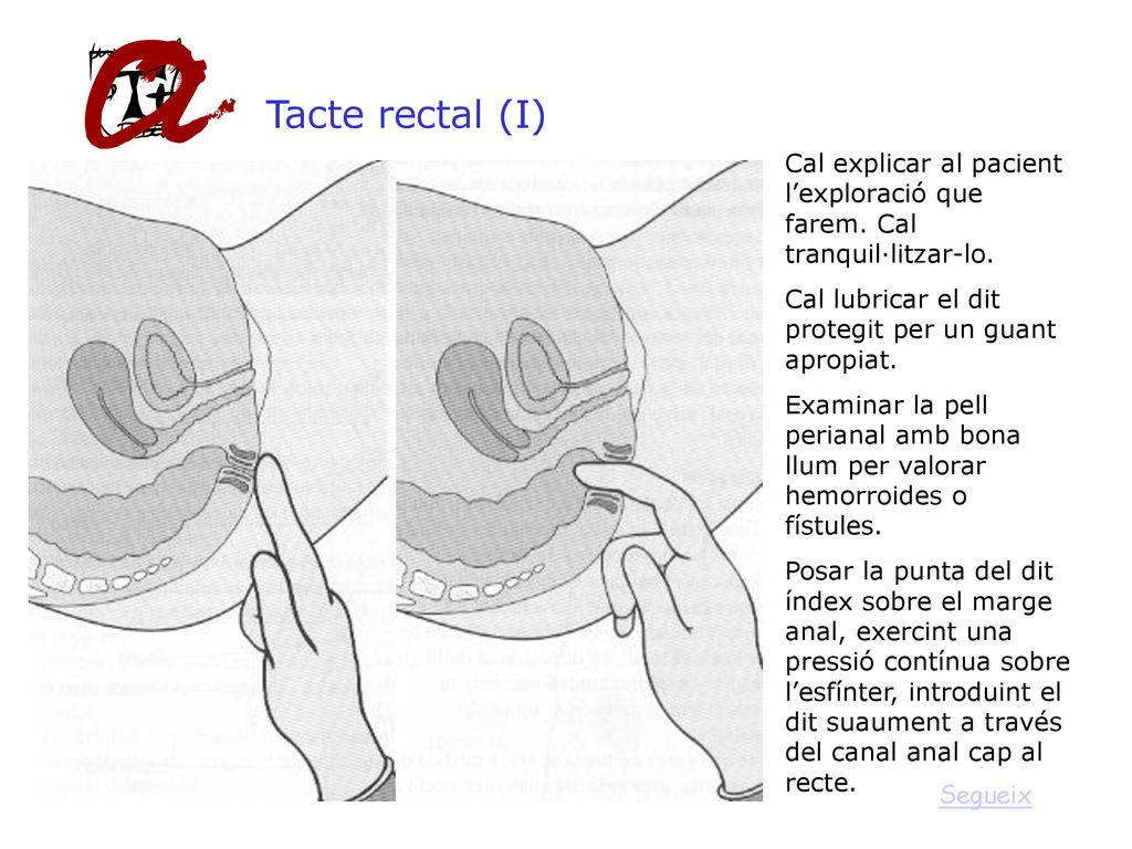 Tacte rectal (I) Cal explicar al pacient l’exploració que farem. Cal tranquil·litzar-lo. Cal lubricar el dit protegit per un guant apropiat.