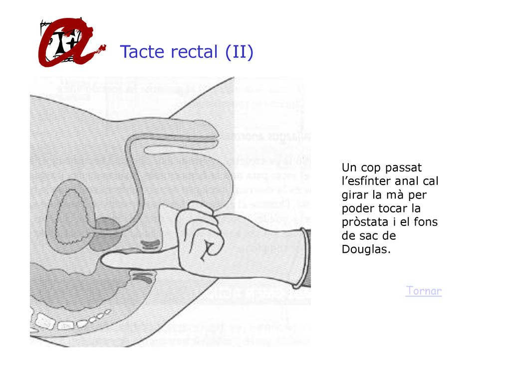Tacte rectal (II) Un cop passat l’esfínter anal cal girar la mà per poder tocar la pròstata i el fons de sac de Douglas.