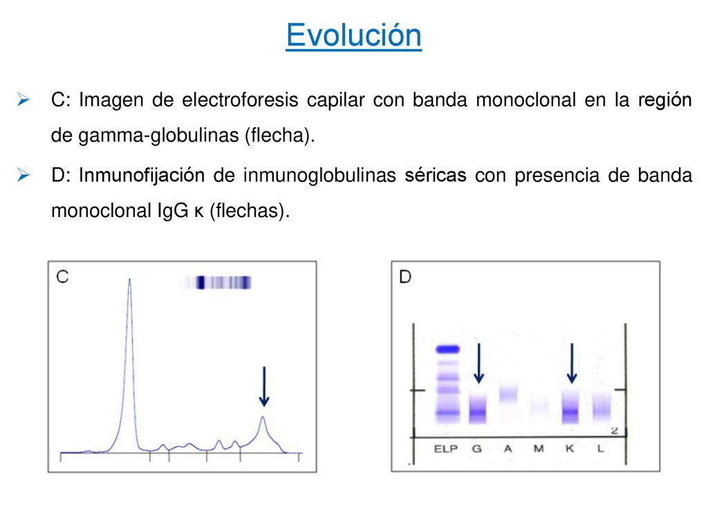 Evolución C: Imagen de electroforesis capilar con banda monoclonal en la región de gamma-globulinas (flecha).