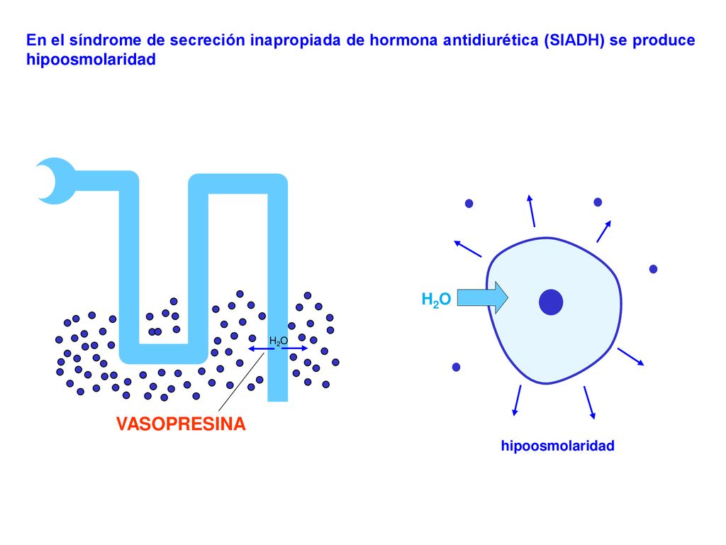 En el síndrome de secreción inapropiada de hormona antidiurética (SIADH) se produce hipoosmolaridad