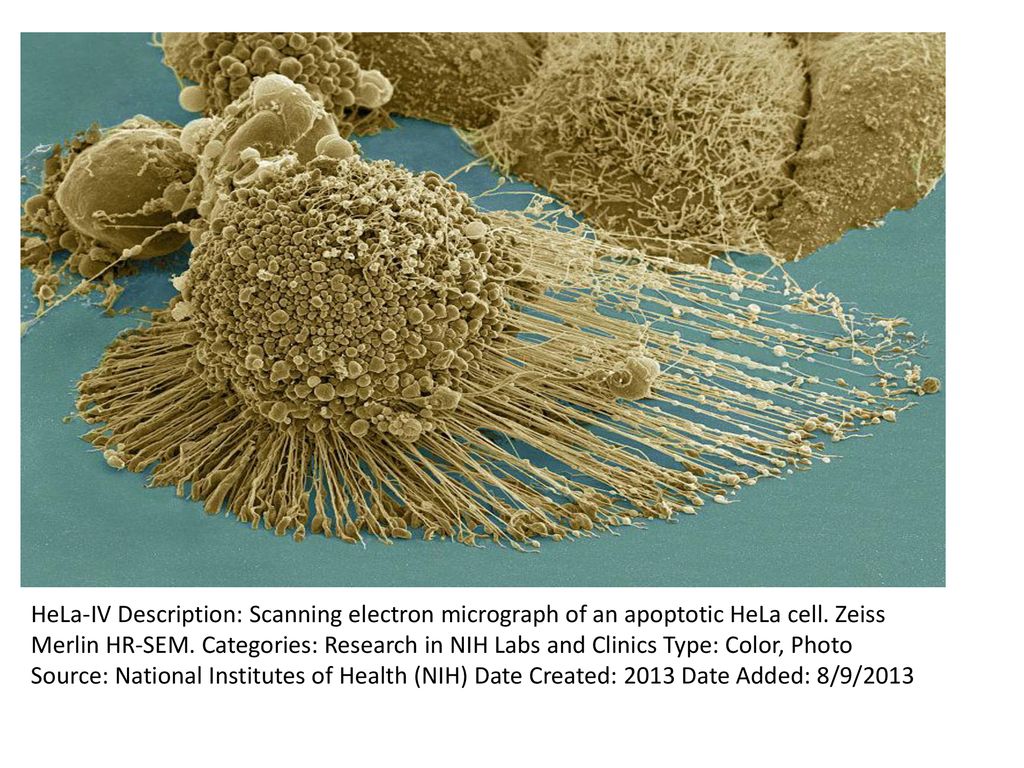 HeLa-IV Description: Scanning electron micrograph of an apoptotic HeLa cell.