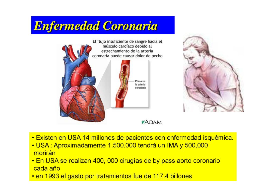 Enfermedad Coronaria Existen en USA 14 millones de pacientes con enfermedad isquémica. USA : Aproximadamente 1, tendrá un IMA y 500,000.