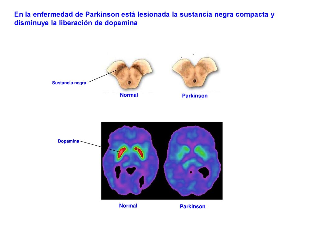 En la enfermedad de Parkinson está lesionada la sustancia negra compacta y disminuye la liberación de dopamina