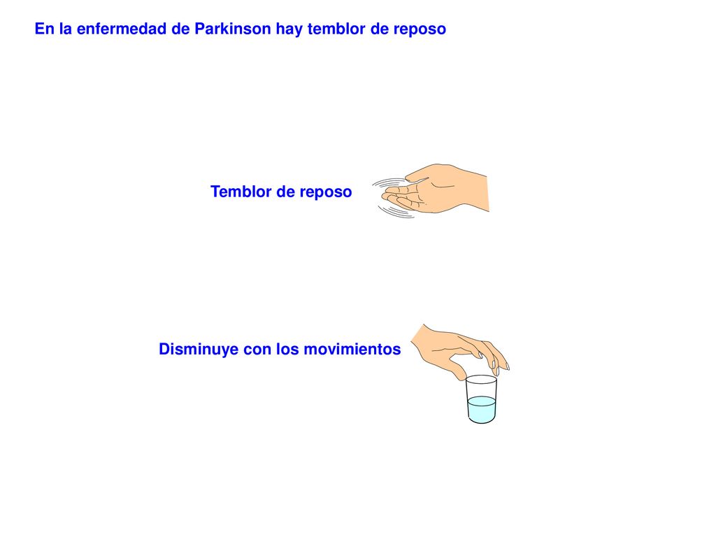 En la enfermedad de Parkinson hay temblor de reposo