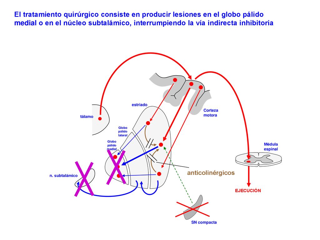 El tratamiento quirúrgico consiste en producir lesiones en el globo pálido medial o en el núcleo subtalámico, interrumpiendo la vía indirecta inhibitoria