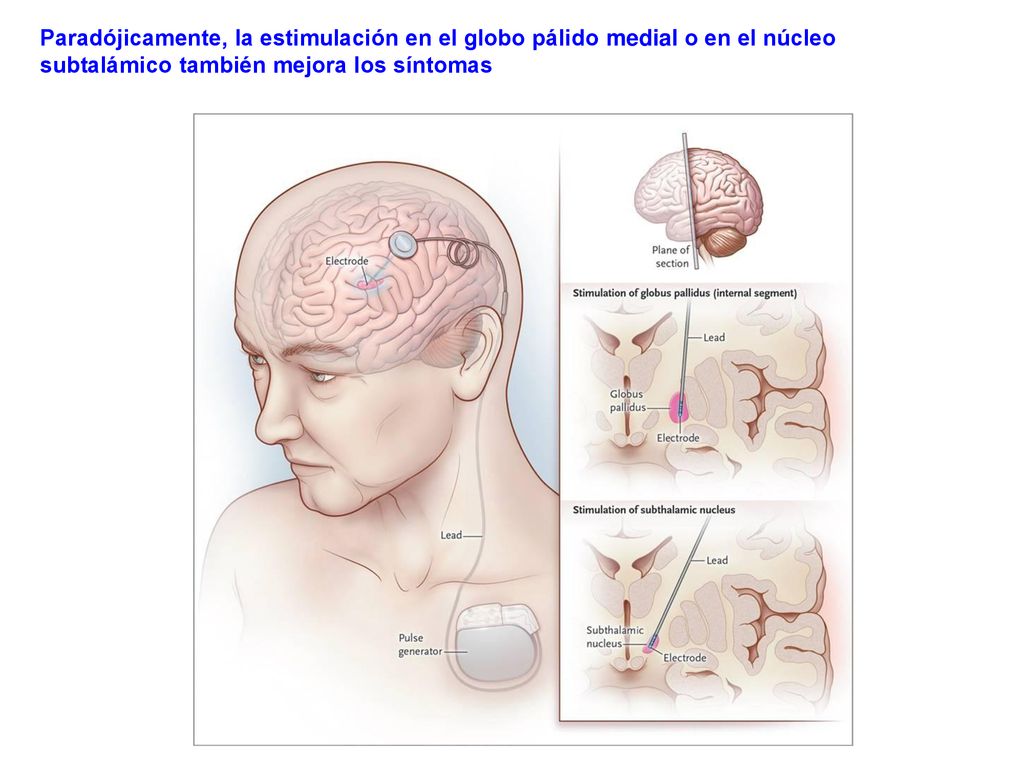 Paradójicamente, la estimulación en el globo pálido medial o en el núcleo subtalámico también mejora los síntomas