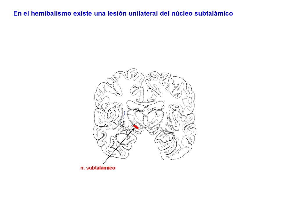 En el hemibalismo existe una lesión unilateral del núcleo subtalámico