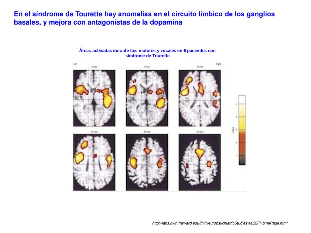 En el síndrome de Tourette hay anomalías en el circuito límbico de los ganglios basales, y mejora con antagonistas de la dopamina