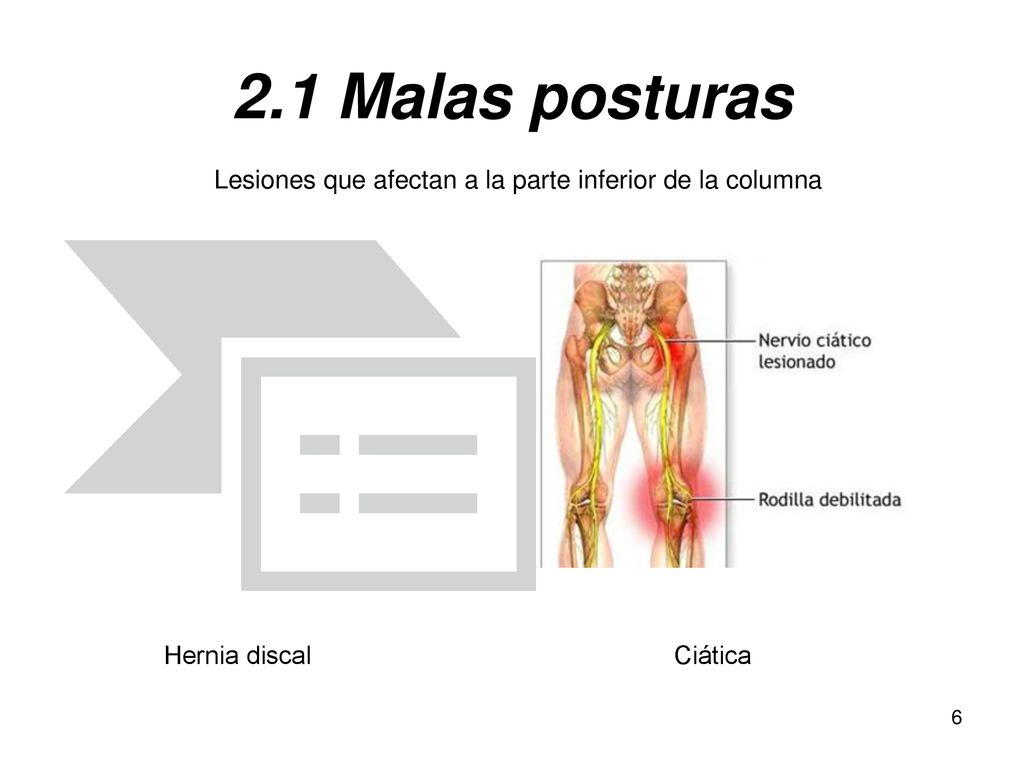 2.1 Malas posturas Lesiones que afectan a la parte inferior de la columna.