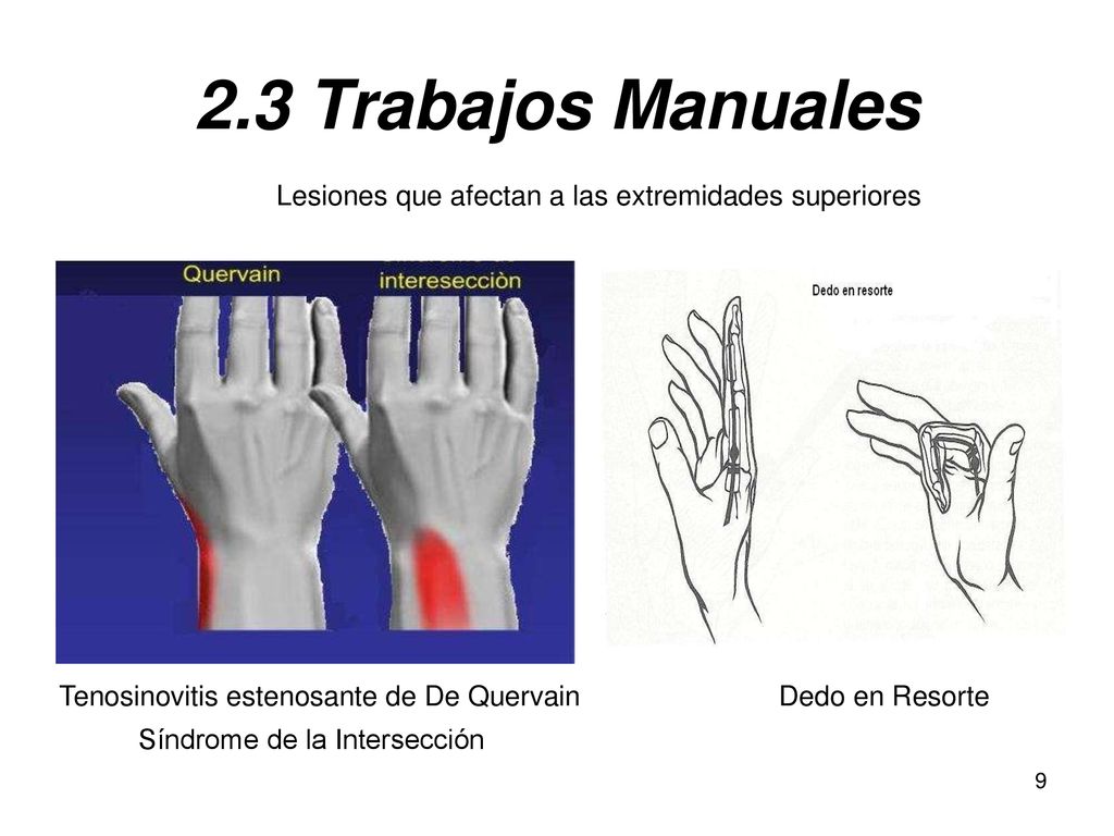 2.3 Trabajos Manuales Lesiones que afectan a las extremidades superiores. Tenosinovitis estenosante de De Quervain.