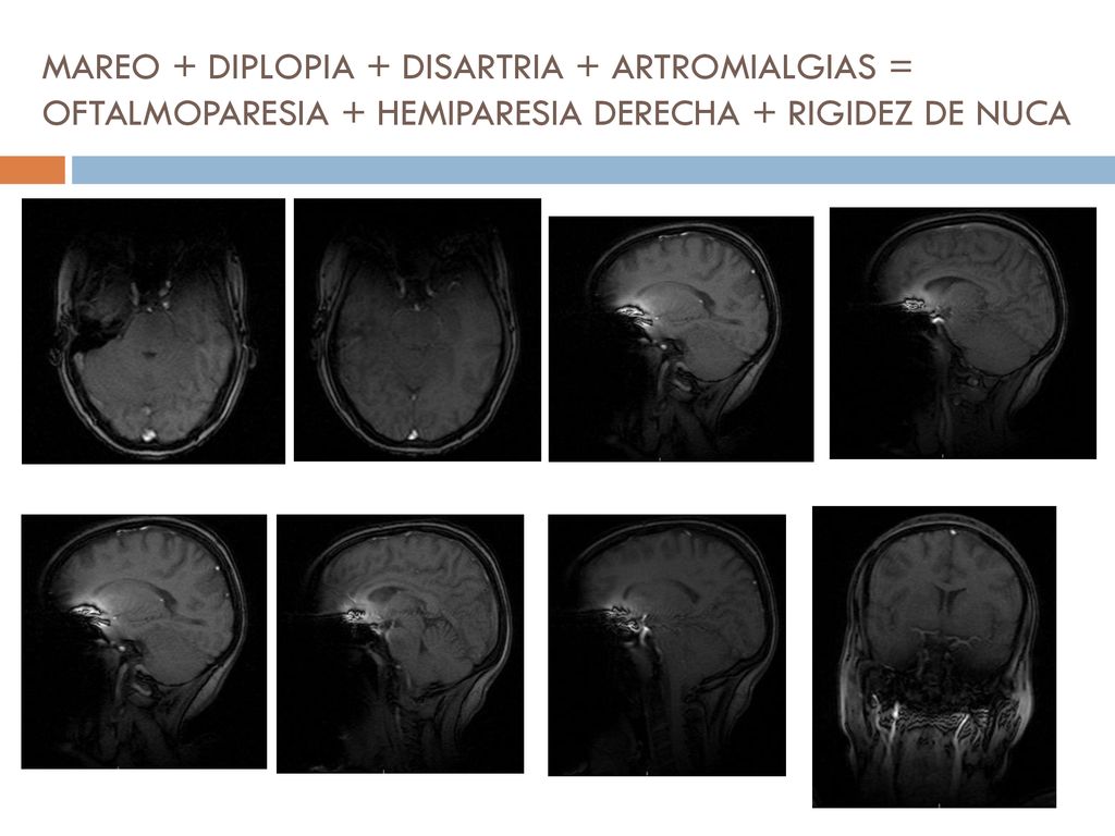 MAREO + DIPLOPIA + DISARTRIA + ARTROMIALGIAS = OFTALMOPARESIA + HEMIPARESIA DERECHA + RIGIDEZ DE NUCA